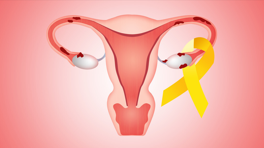 子宫内膜异位症怎么确诊？